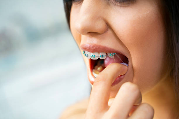 Rubber Bands in Braces: What Are Their Functions?