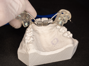 A dental expander held next to an impression of a patient's upper arch of teeth.